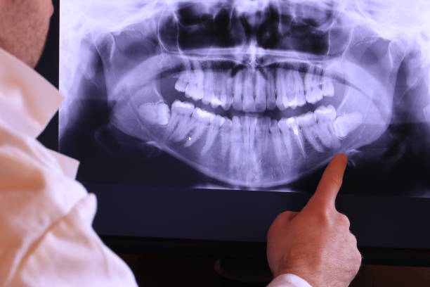 Best Root Canal Emergency Dentist  in Brookdale, CA